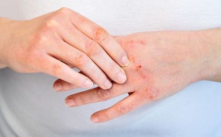 乳膠手套能否有效防止長水泡？